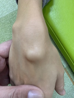和泉市 整体 笑福整骨院【ガングリオンの施術】